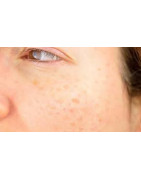 Melasma / Freckle